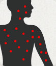 Image depicting measles