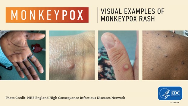 Images of monkeypox lesions