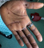 picture of monkeypox rash on the palm of a hand