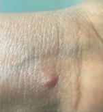 picture of monkeypox rash on a wrist