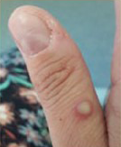 picture of monkeypox rash on a thumb