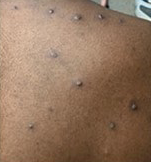 picture of monkeypox rash on a person's back