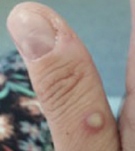 Mpox on thumb