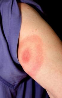 Bull's eye rash from Lyme disease on person's arm.