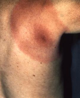 Bull's eye rash from Lyme disease.