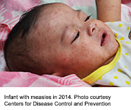An infant with measles