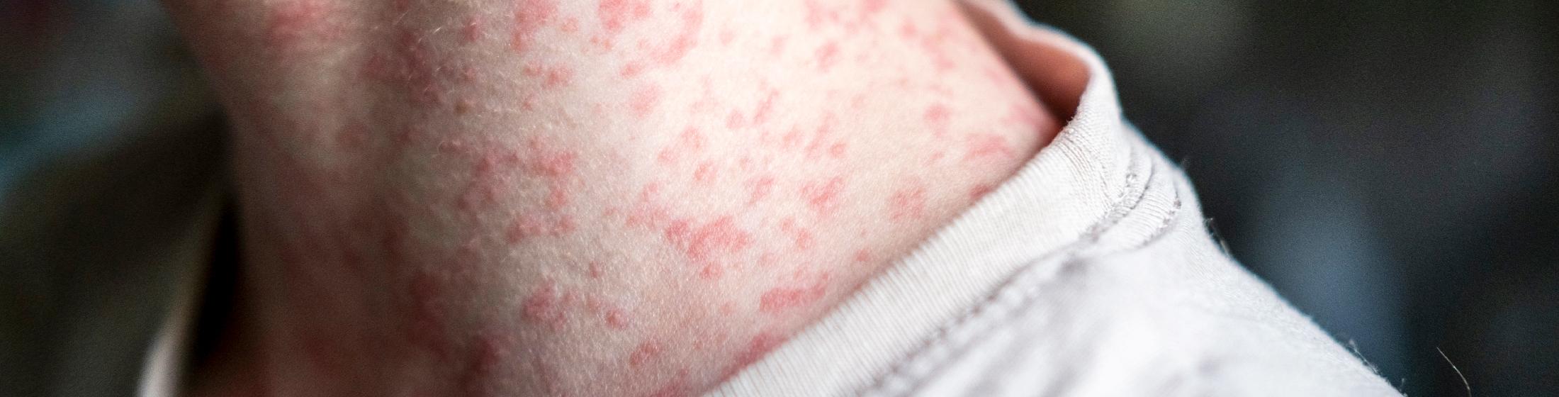 A closeup of a person's neck who has measles.